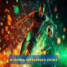 eritema infeccioso fotos